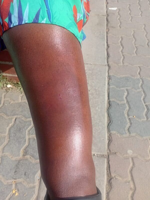 The swollen leg of Nthabiseng Nthama who got injured at work on August 07,2026. Photo: Reitumetse Gugushe
