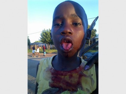 The five year old child who sustained injuries.