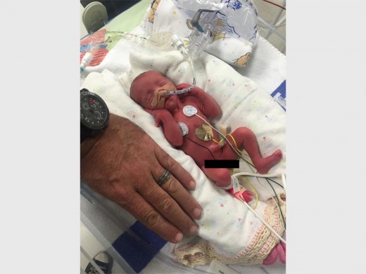 The size of McKayla (triplet one) at birth, compared with her daddy Gareth's hand. She weighed 805g.