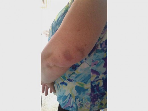 Susanna Yssel shows the bruises she suffered on her arm, after being hijacked.