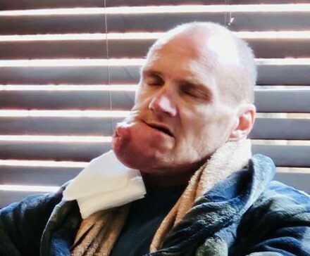 After being diagnosed with aggressive jaw cancer, Jaco's only hope lies in urgent surgery.