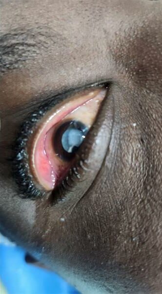 Armed with scopes, skill, and compassion, healthcare workers at Tambo Memorial Hospital performed 27 life-changing procedures, including 16 cataract surgeries to reduce surgical backlogs and bring clarity back to patients' lives.