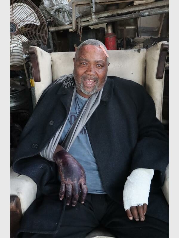 An elderly black man sitting in an armchair with his arm in a sling and burn wounds on his hands.