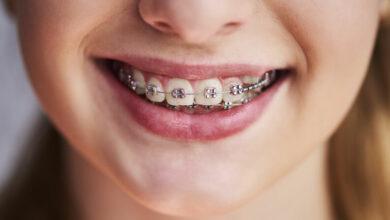 Does my child need braces?