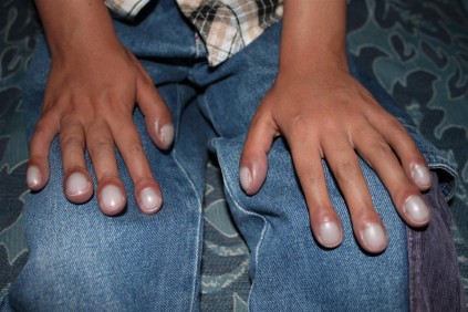 Clinton Botha also has club fingers due to his heart condition.