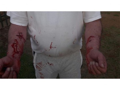 QUENTIN McCullough shows the wound he sustained in the attack.