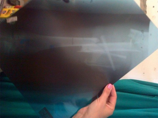 THE X-ray showing where Moolman's femur in his left leg was broken.