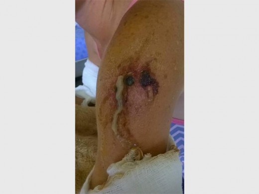 THE wound on the woman's right arm when she was admitted to Tembisa Hospital.