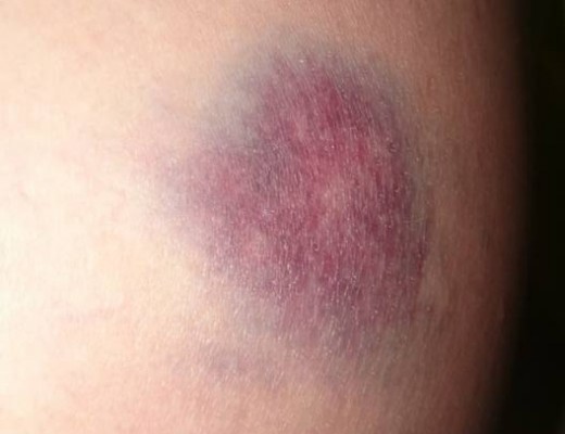 a12 attacked (bruise)