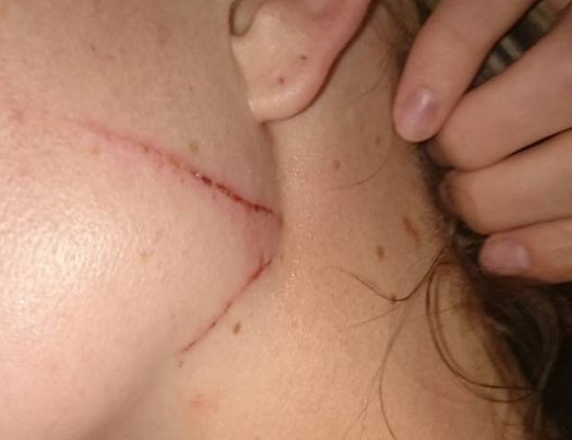 The neck wound Taschia sustained.