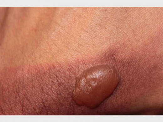 Second degree burn.