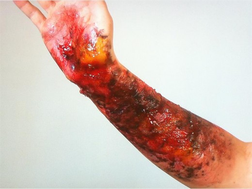 Third degree burn.