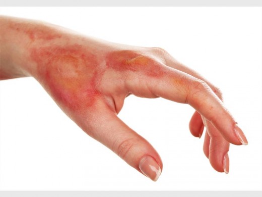 First degree burn.