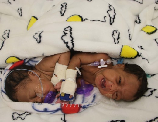 The two gorgeous little girls, Uwenzile and Uyihlelile Shilongonyane, being prepared for separation surgery today at Netcare Unitas Hospital in Centurion.