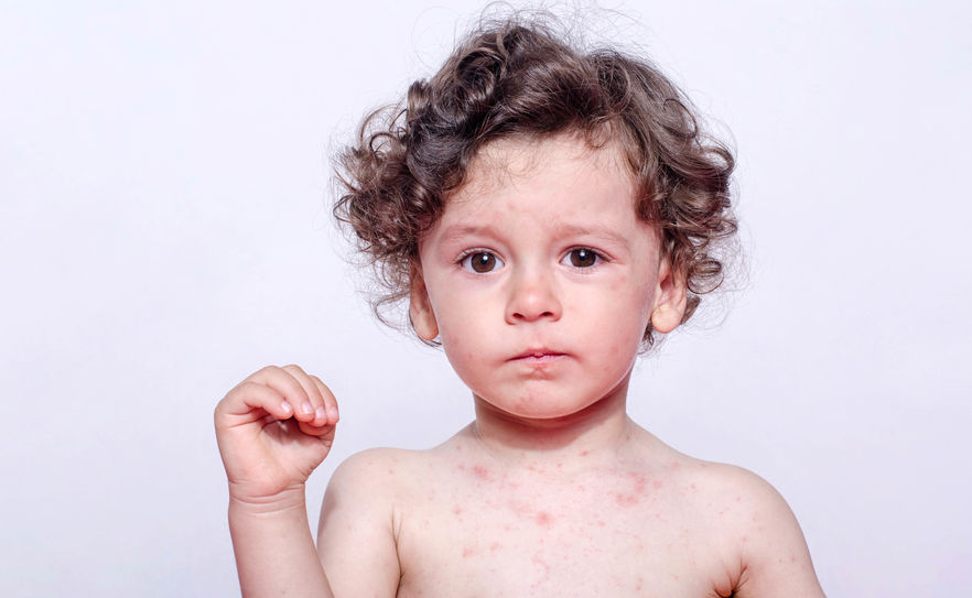 What all parents need to know about chickenpox