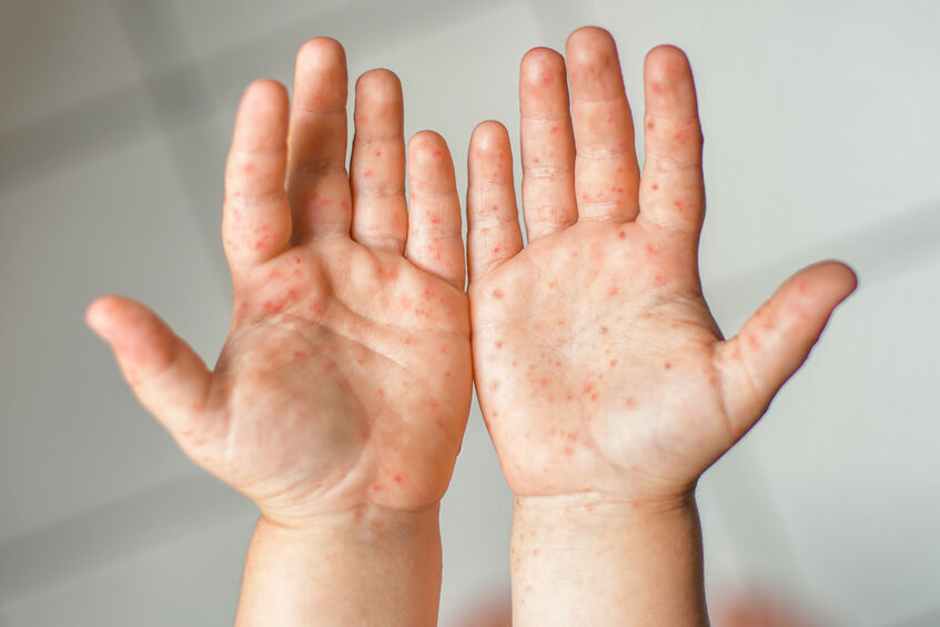 All about Hand, Foot, and Mouth Disease in kids