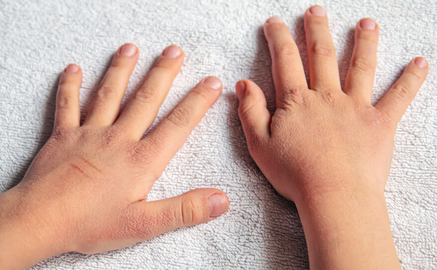 How to treat your child’s dry skin in winter