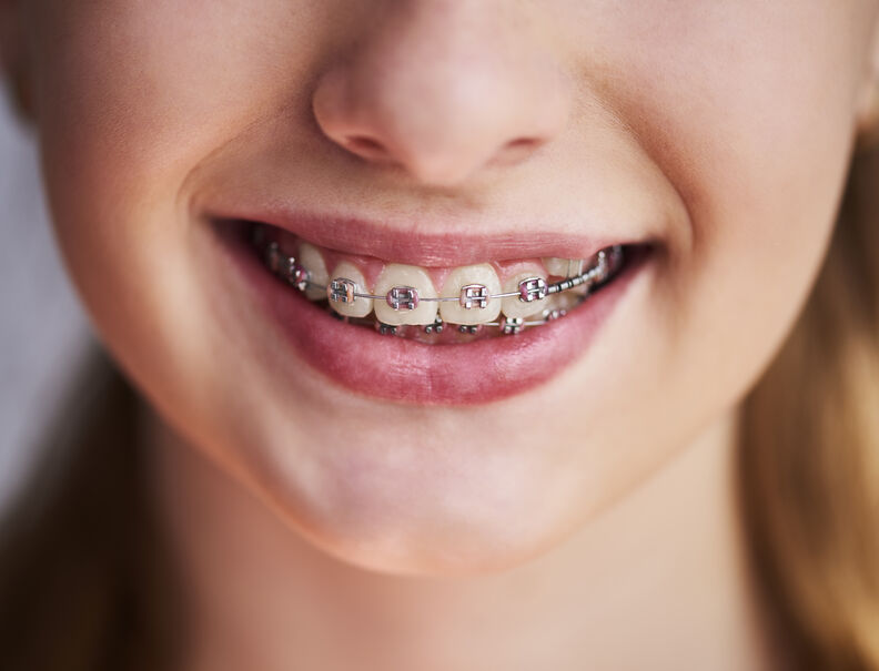 Does my child need braces?