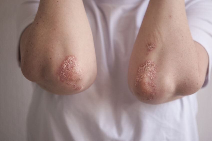 All about psoriasis in children