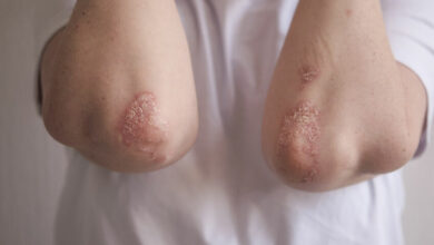 All about psoriasis in children