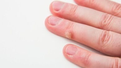 How to treat warts in children