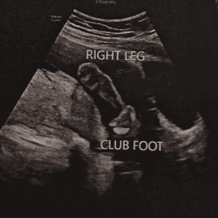 a pregnancy scan showing a baby diagnosed with club foot