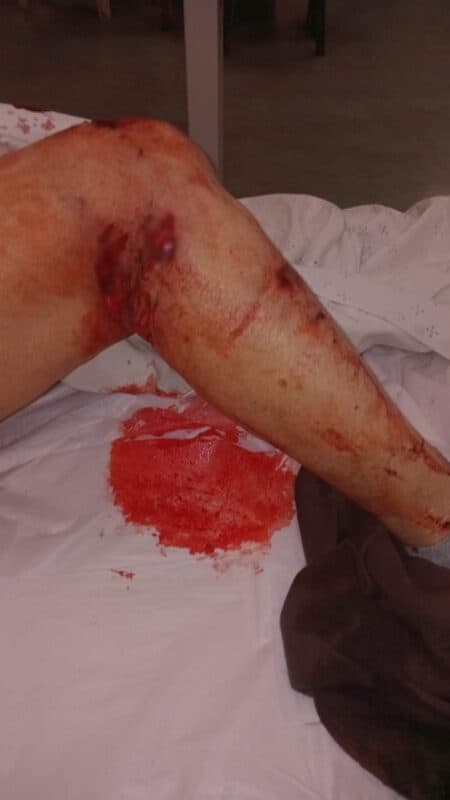 Bite marks on the leg of the victim bent on a blood stained sheet.