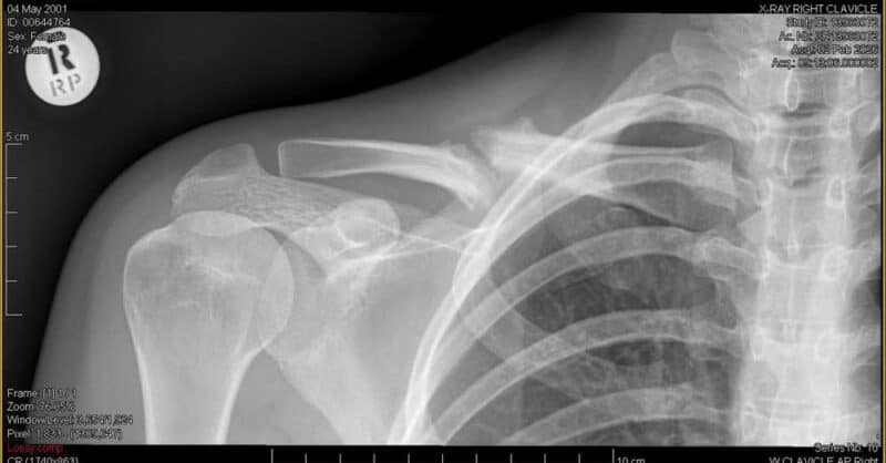 Amber Rose Schmuhl's clavicle which has not healed over time.