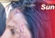 The Merebank woman sustained serious facial injuries.