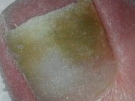 When fungus under the nail is greenish in colour, the situation is called "greenies."