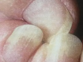 Injury may cause the nail to separate from the nail bed, placing the area at risk of infection.  Original Image: Young Nails SA.