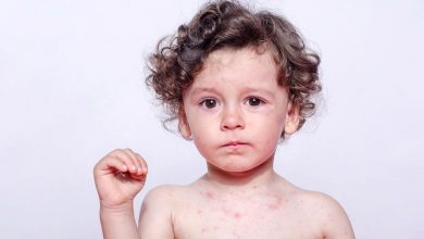 Chickenpox: What’s that spot you’ve got?