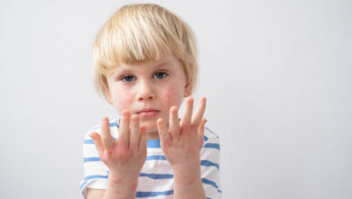 The link between eczema and mental health