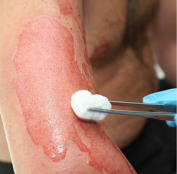 From minor discomfort to life-threatening emergencies, burn injuries are distressingly common and a major cause of death and disability in South Africa.