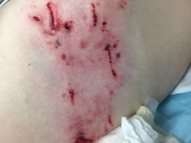 Kayla, also suffered several puncture wounds in the attack.