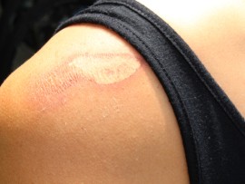 She also suffered bruising and cuts to her knees, back and buttocks.