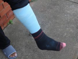 Ally's leg will be in a cast for the next month and a half.