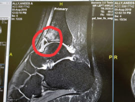 An x-ray showing the crushed tibia.