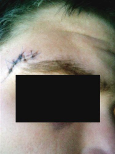 It took five stitches to close the wound.