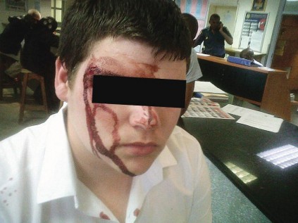 Blood pours down the pupil's face.