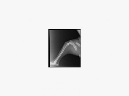 An x-ray shows severe bone damage which cannot be repaired.