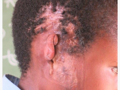 Amahle's right ear which was damaged in an accident in 2010 which left her scarred and in pain.