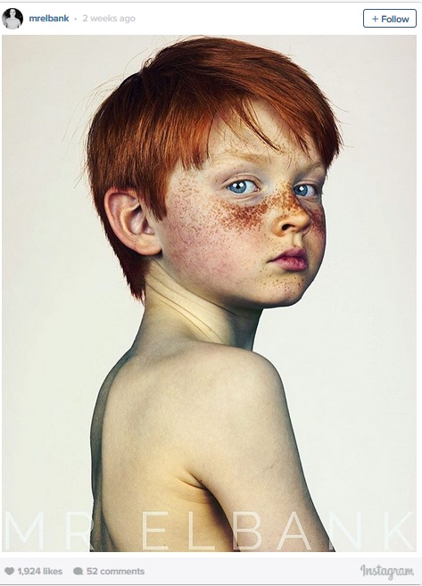 Freckle1