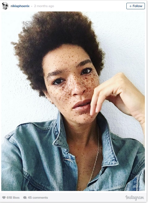 Freckle3