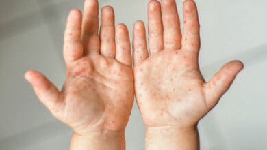 All about Hand, Foot, and Mouth Disease in kids