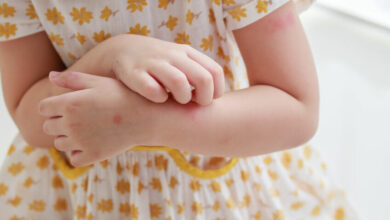 How to treat your child's skin rash