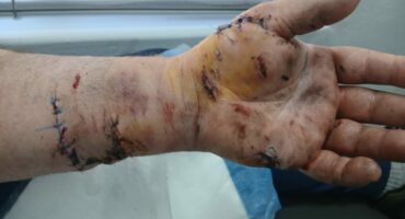 Pitbull attack leaves man severely injured