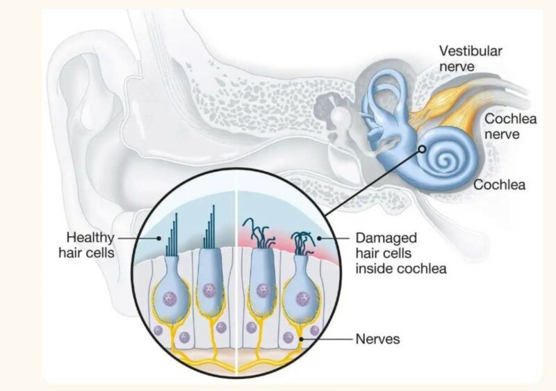 Medical illustration of the inner ear showing the cochlea and vestibular nerve, with a magnified inset comparing healthy hair cells to damaged hair cells inside the cochlea.
