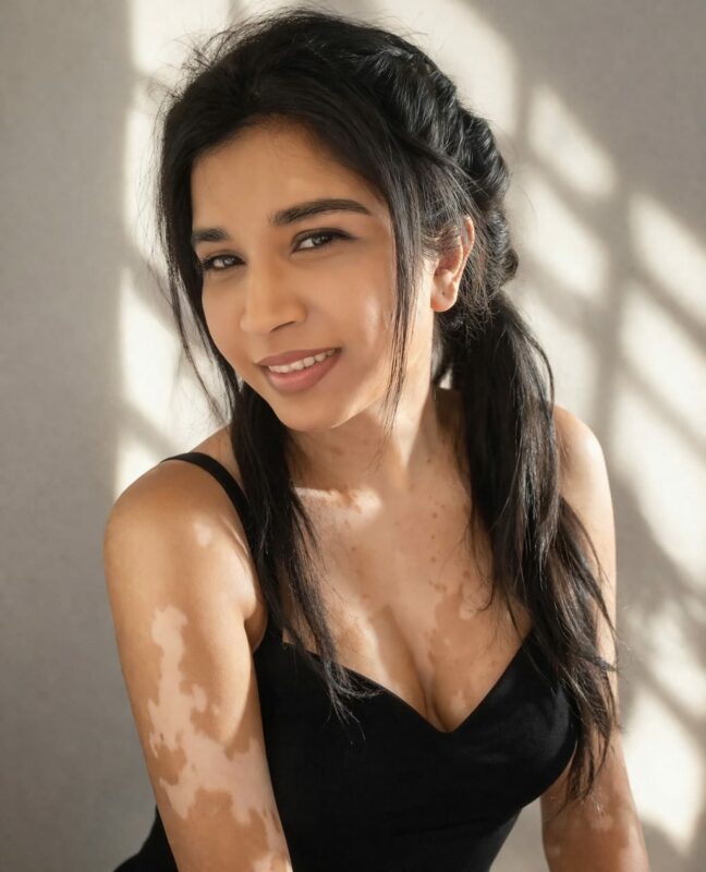 A woman who has Vitiligo poses for a portrait photo.