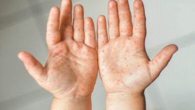 All about Hand, Foot, and Mouth Disease in kids